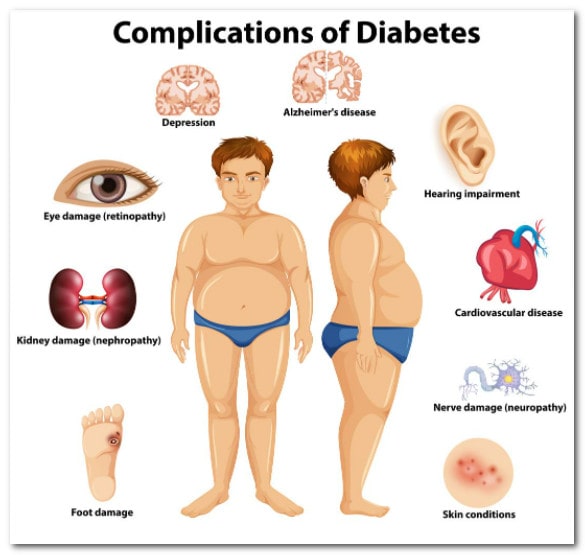 Common Complications Of Diabetes Mellitus, Diabetologist is specialist for treating the complications of diabetes