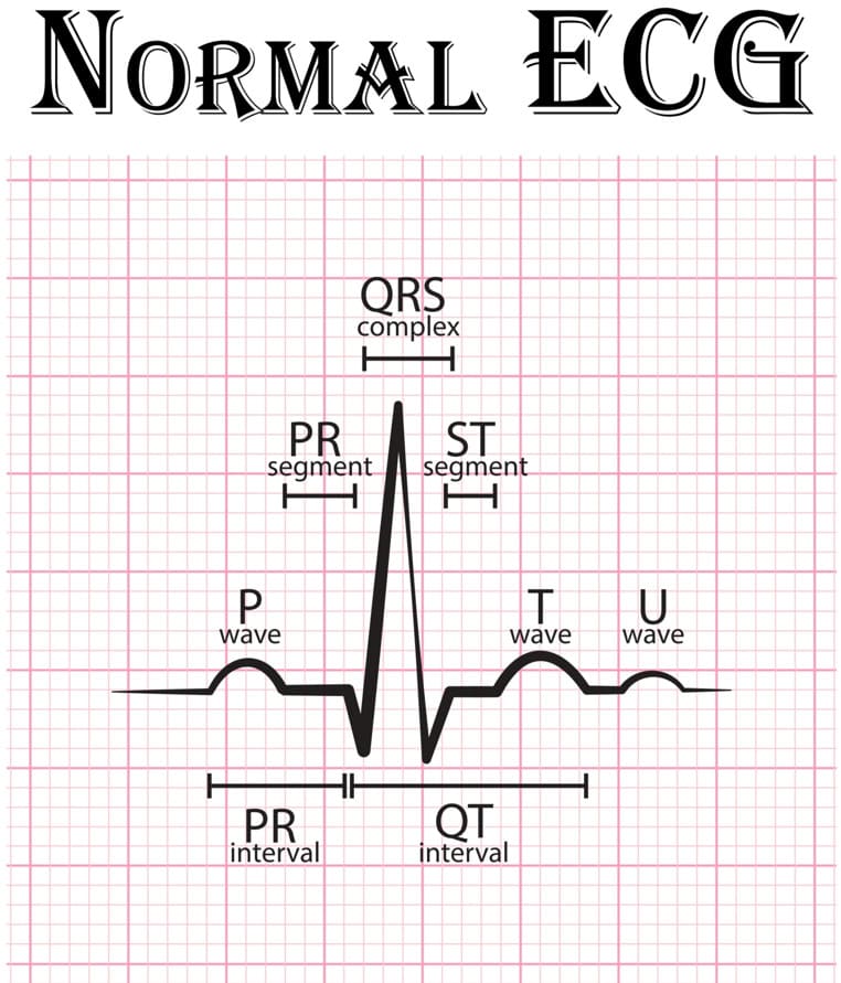 P waves and QRS waves in cardiac ECG