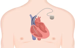 pacemaker surgery for bradycardia