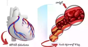 What are coronary artery and coronary heart disease in telugu language | కరోనరీ ఆర్టరీ డిసీజ్ అంటే ఏమిటి ? | కరోనరీ ఆర్టరీస్ అంటే ఏమిటి ?